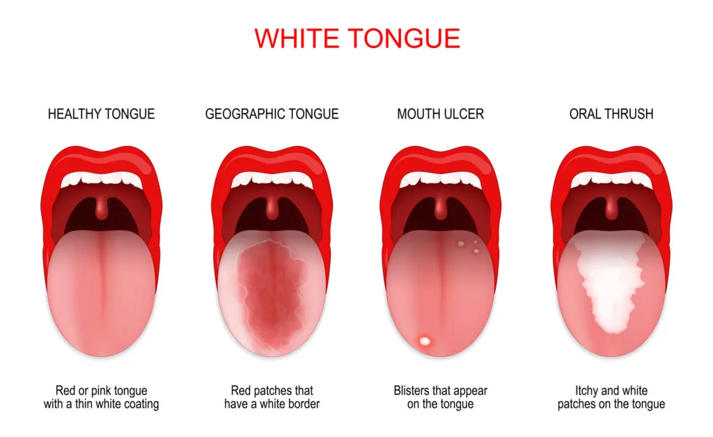 Sore or white tongue. comparison of healthy tongue and oral disease as causes of white spots on tongue