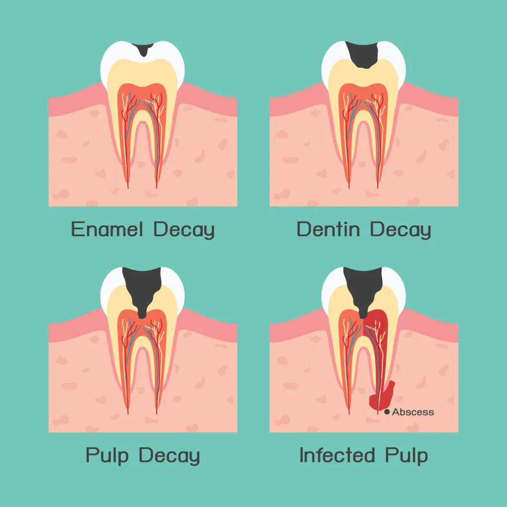Stages of Tooth Decay Illustration