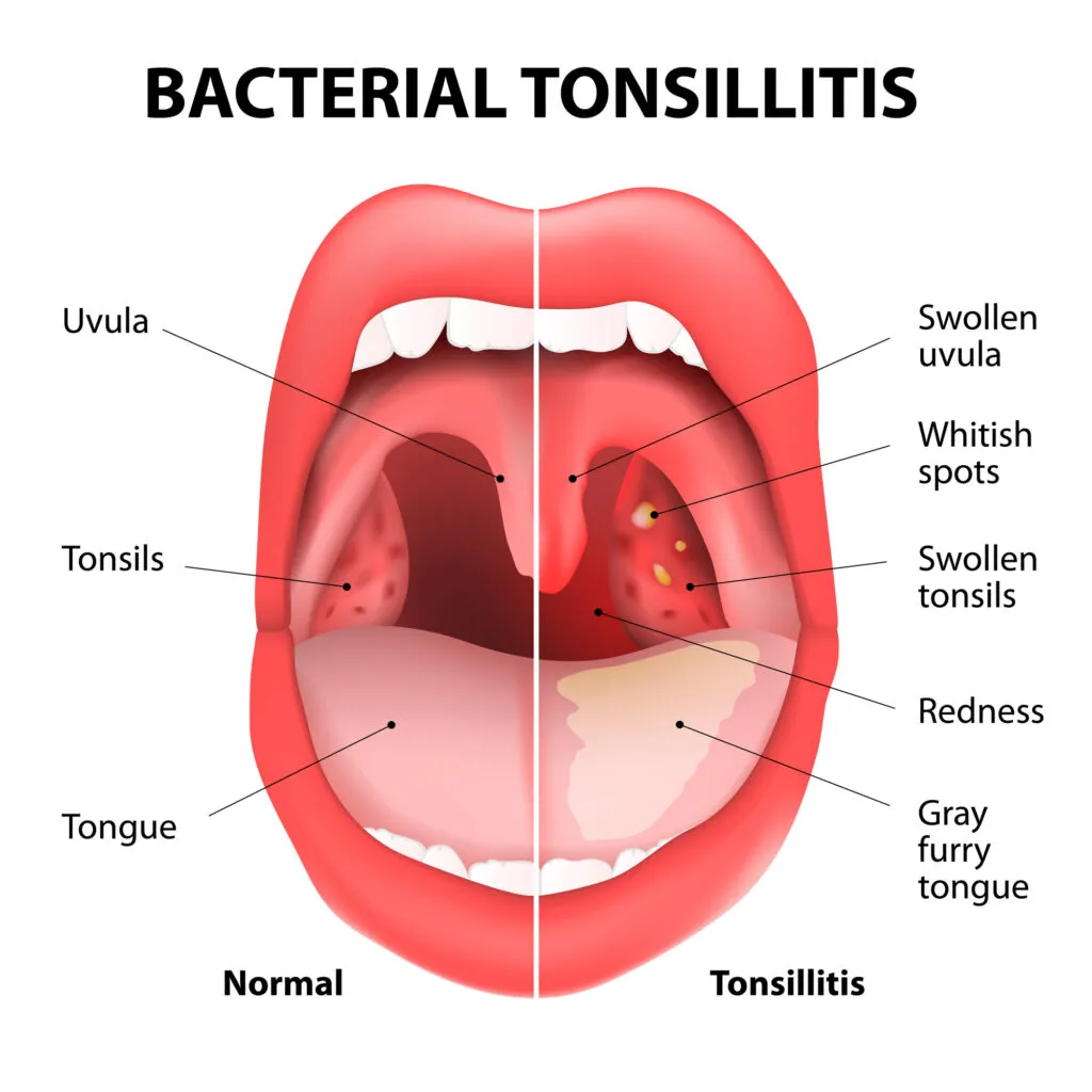 Strep Throat medical illustration