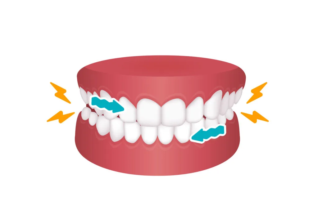 Teeth grinding or Bruxism vector illustration