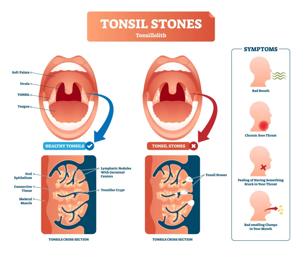 Tonsil stones vector illustration labeled medical tonsillolith symptoms