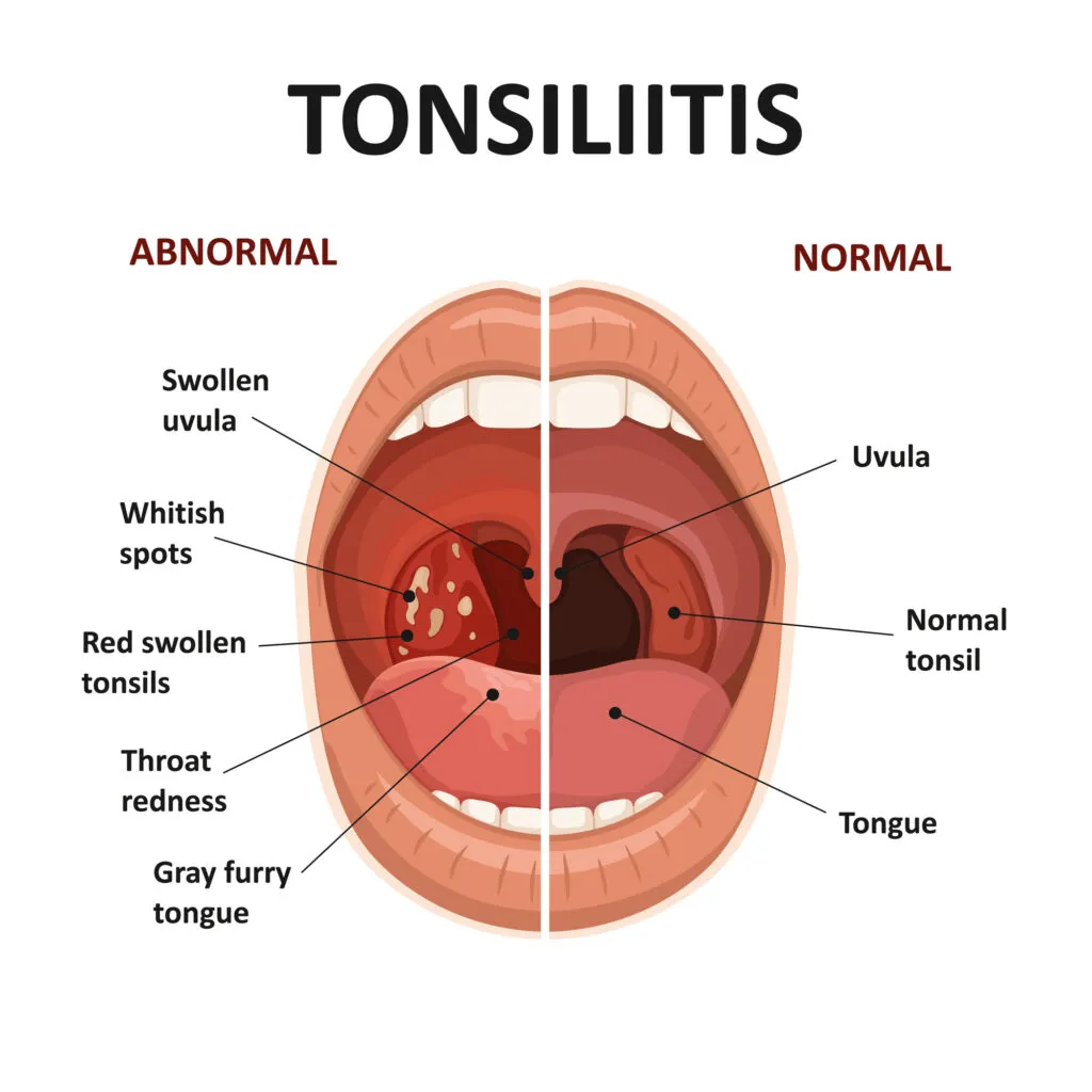 Tonsilitis medical illustration