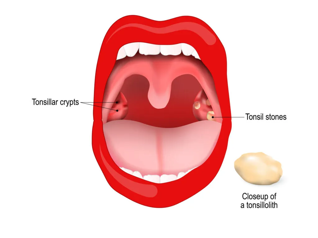 Tonsillolith lodged in the tonsillar crypt. close up of the tonsil stones edited