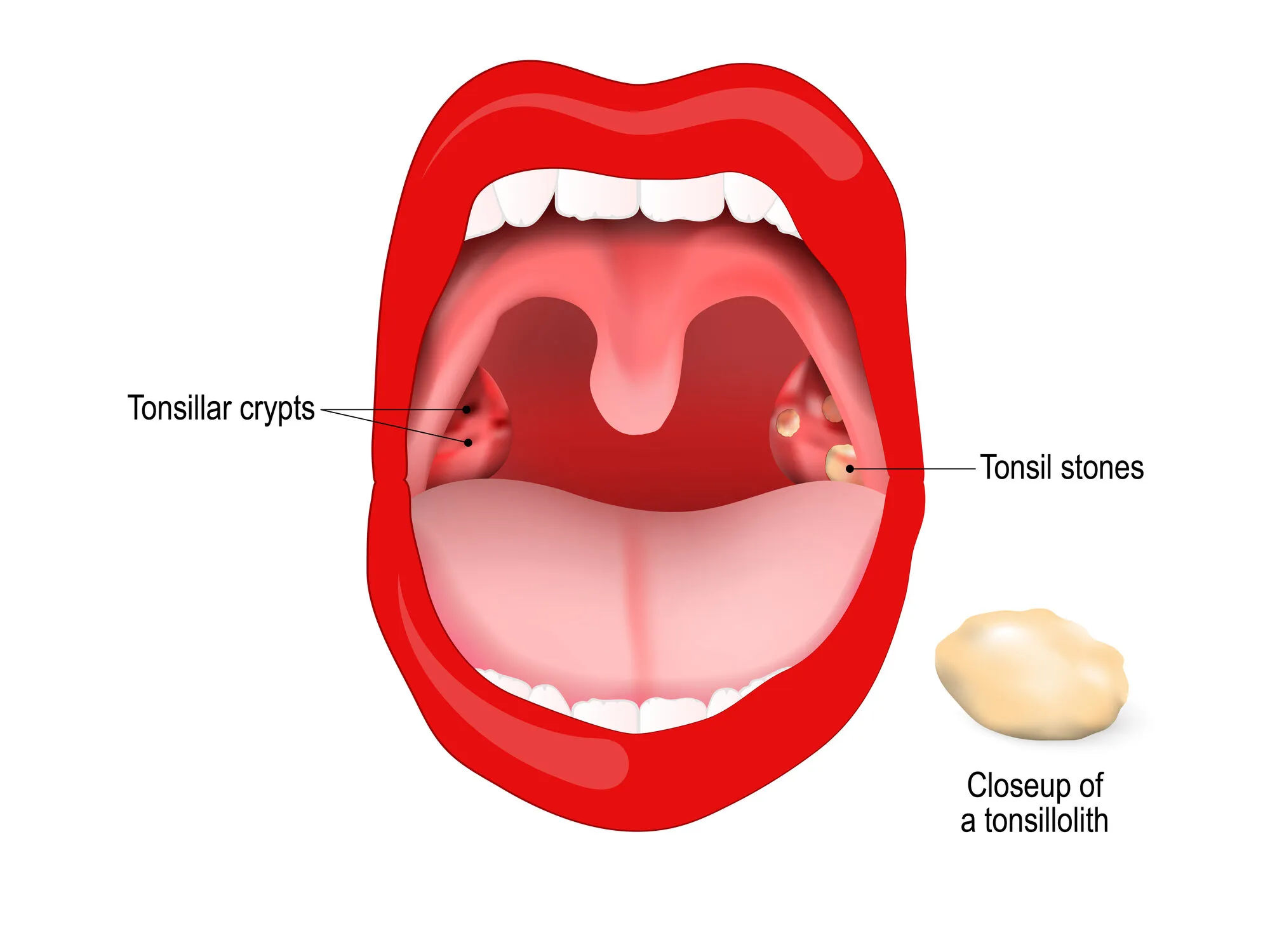 Tonsillolith lodged in the tonsillar crypt. close up of the tonsil stones