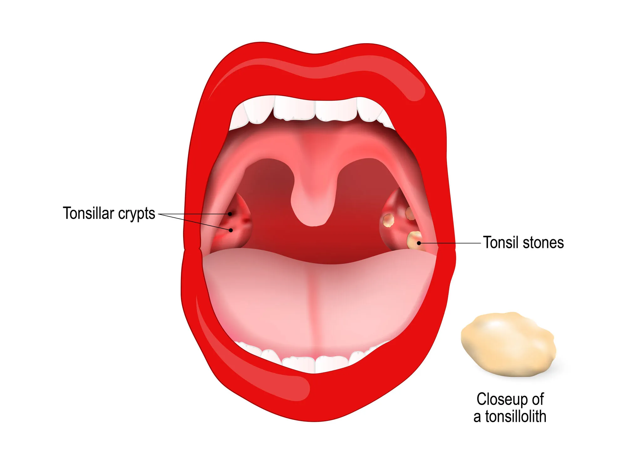 Tonsillolith lodged in the tonsillar crypt. close up of the tonsil stones