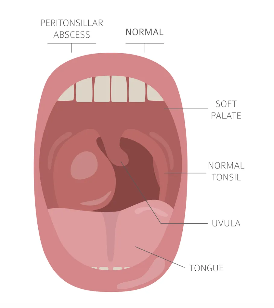 Tonsils and throat diseases. Peritonsillar abscess symptoms comparison vs. the normal throat