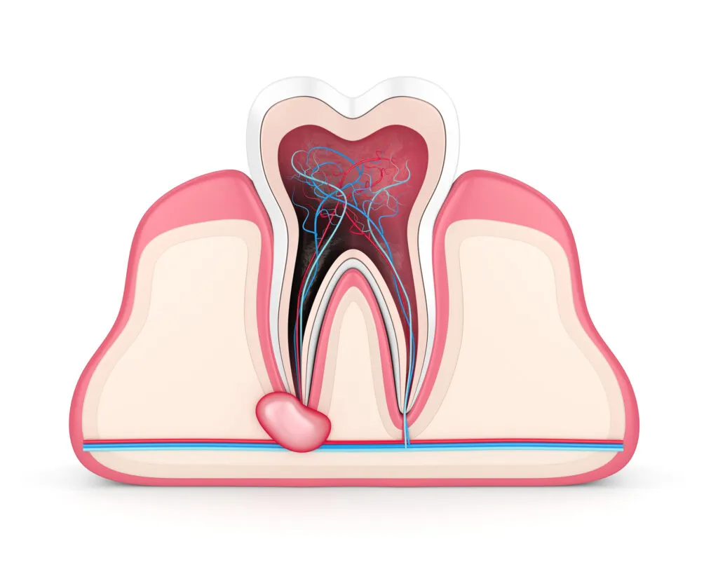 Tooth Abscess illustration