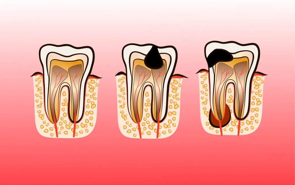 Tooth abscess progression through vector illustration