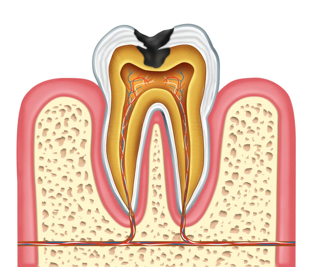 Tooth cavity illustration