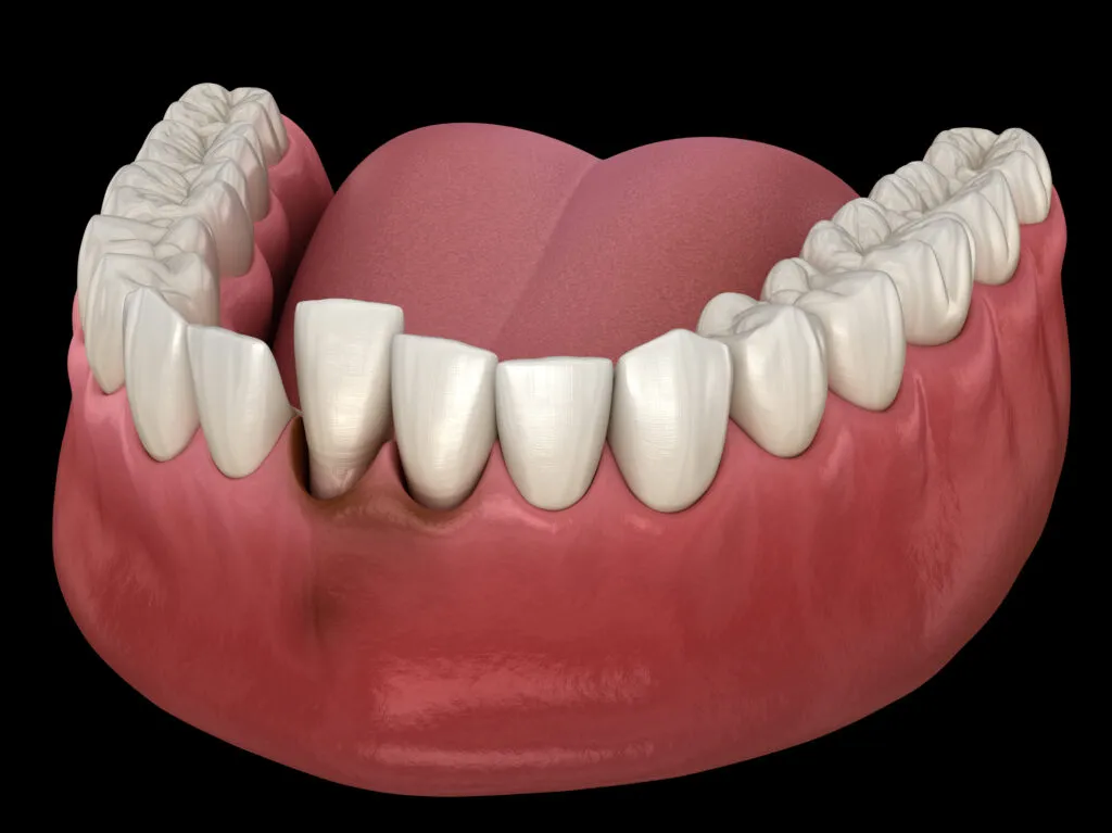 Tooth dislocation after trauma. Medically accurate 3D illustration