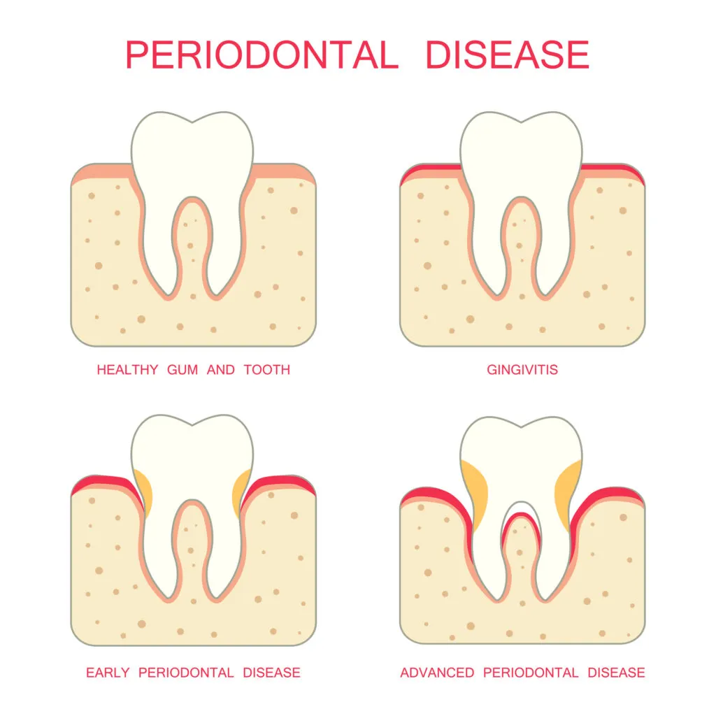 Tooth periodontal diseases progressions from a normal tooth illustrations