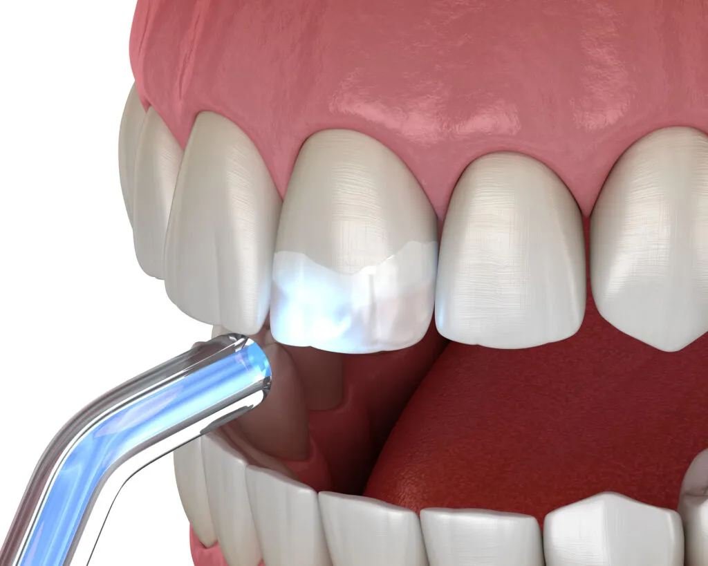 Tooth restoration or teeth contouring with filling and polymerization lamp