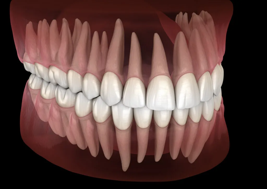 Translucent Teeth medical image