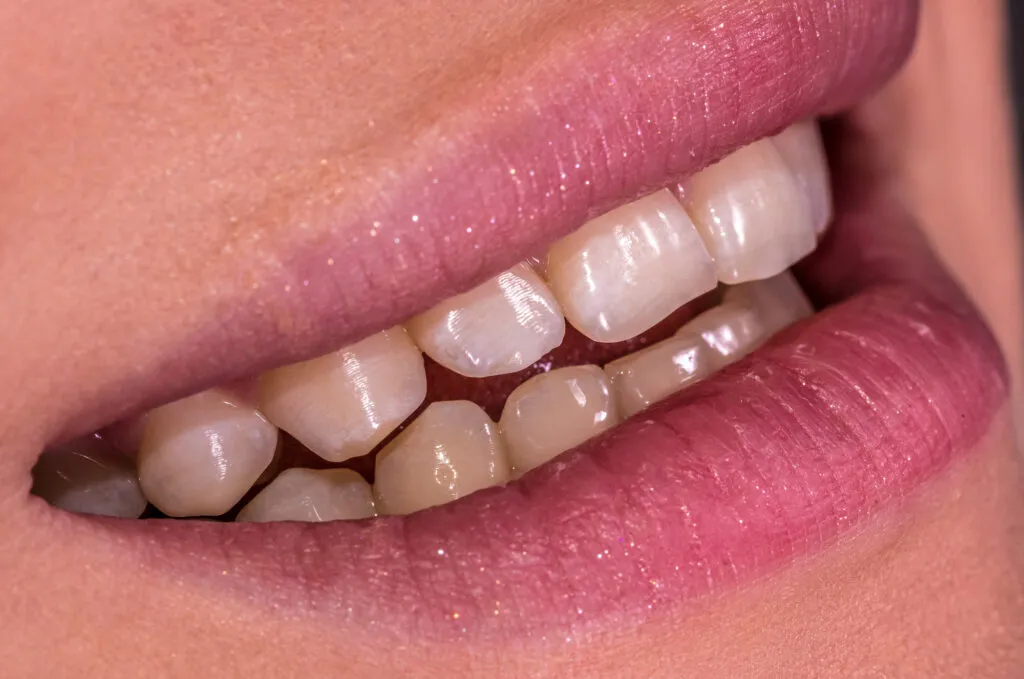 Translucent Teeth medical image 2