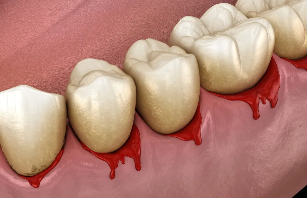 Trench mouth or bleeding gums which is a pathological inflammatory condition of the gums