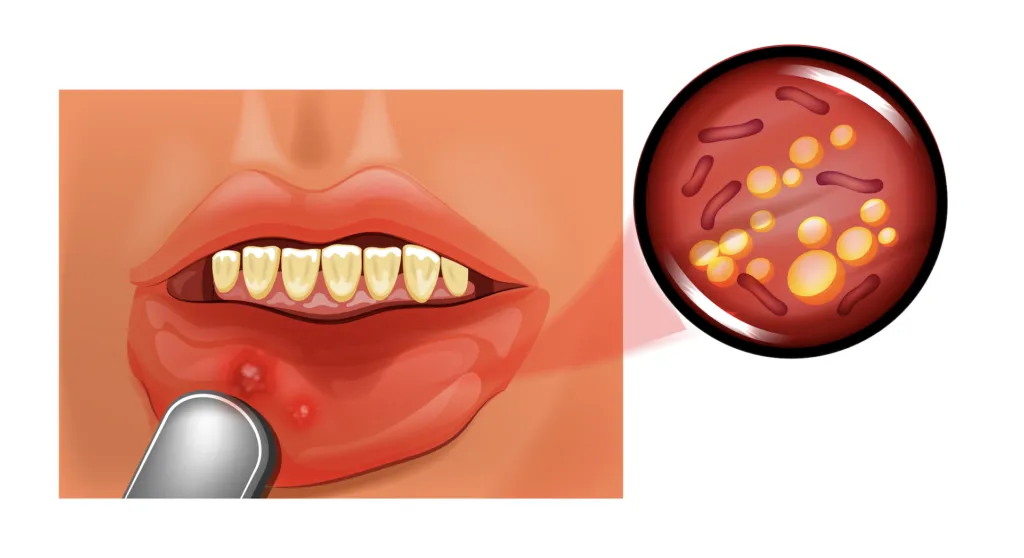 Vector illustration of aphthous stomatitis