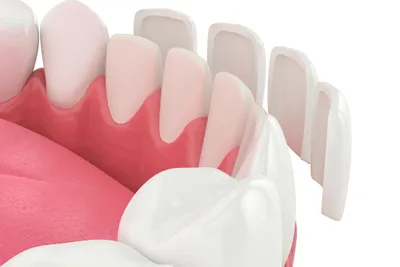 How Much Veneers Cost & Ways to Pay for Them