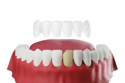 What Are Veneers?