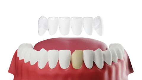 What Are Veneers?