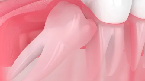 What Are Wisdom Teeth?