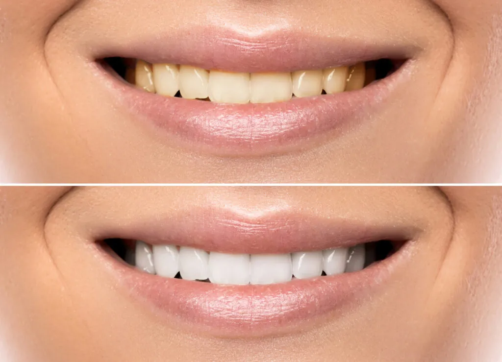 Yellow teeth of woman in comparison to white teeth