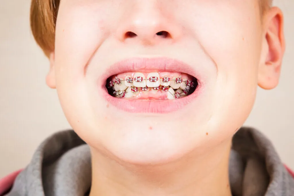 Young boy wearing braces showing his swelling gums in a studio shot
