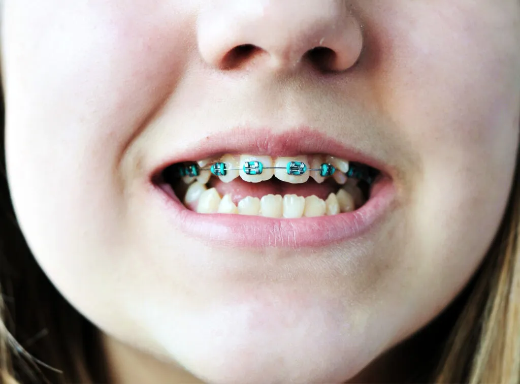 Young girl wearing braces to help her crooked teeth