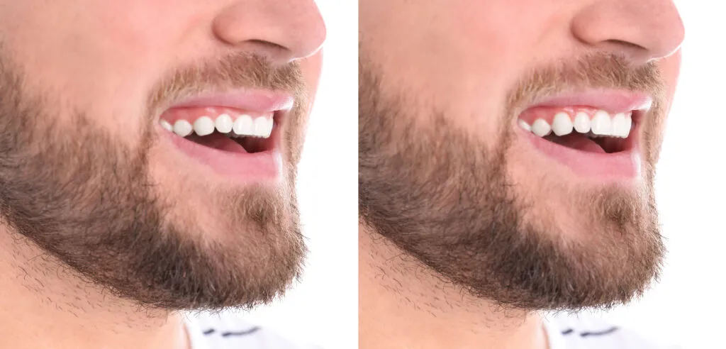 Young man before and after gingivoplasty procedure on white background