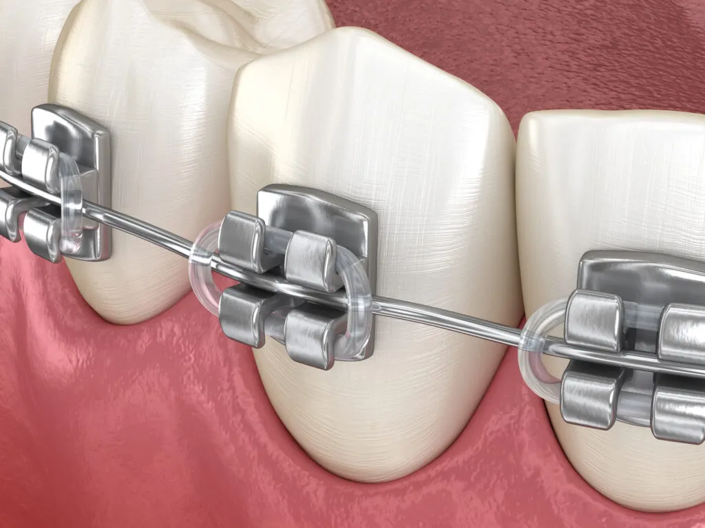 Zoomed in 3d render of Healthy Teeth with metal braces