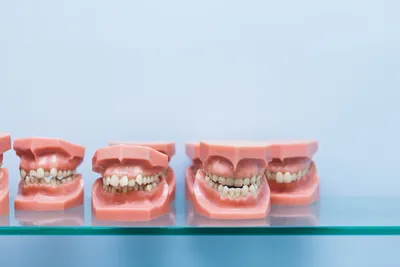 What Are Pacifier Teeth?