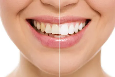 Teeth Whitening Costs