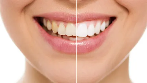 Teeth Whitening Costs