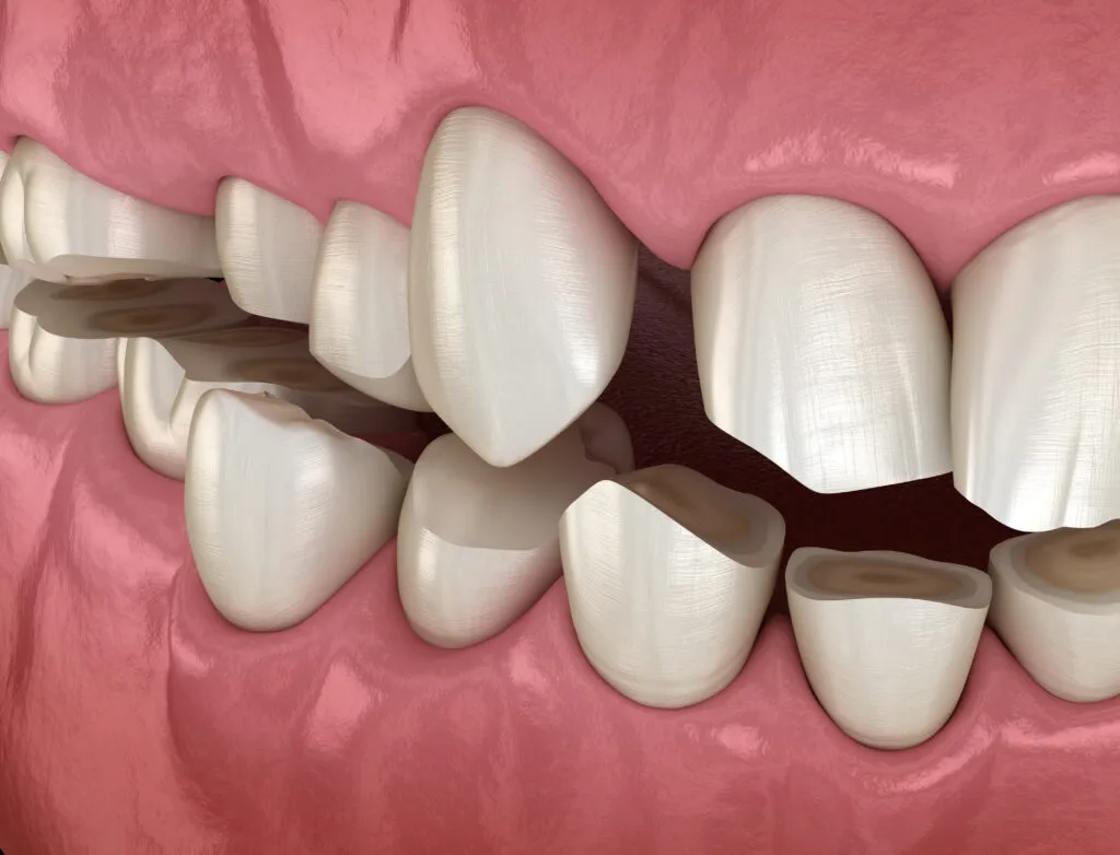 Dental attrition (Bruxism) resulting in loss of tooth tissue. Medically accurate tooth 3D illustration