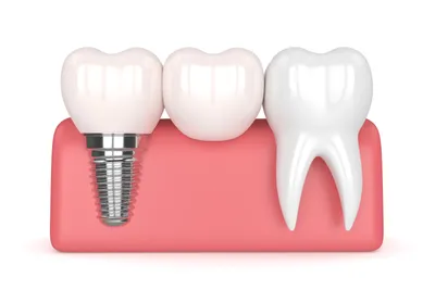 What You Need to Know About Dental Bonding