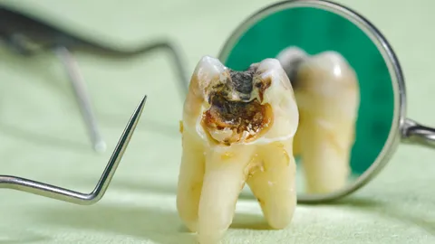 Can Cavities Go Away on Their Own?