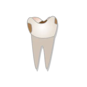 Class ii cavity