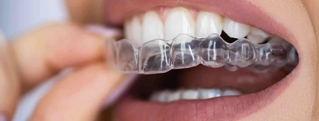 Clear aligner