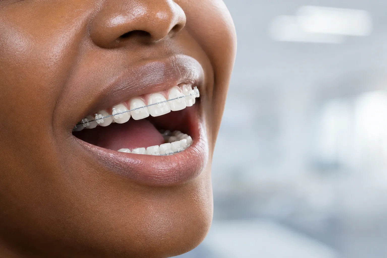Clear braces close up shot on a woman s teeth nm 0614