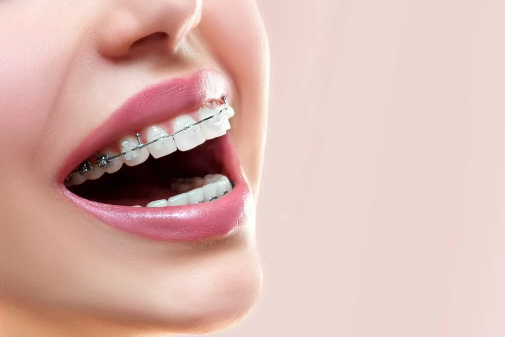 Clear braces close up shot on a woman s teeth
