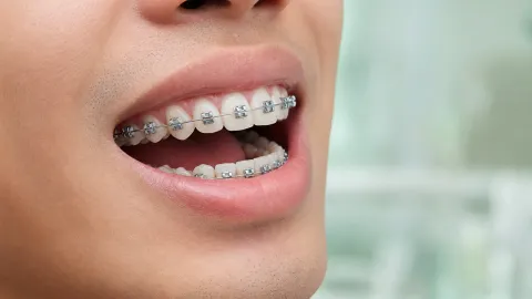 What are Damon Braces?