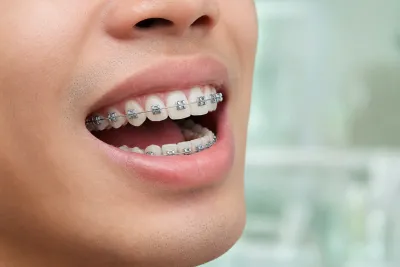 What are Damon Braces?
