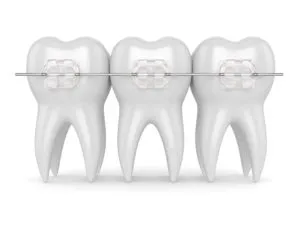 Clear bracesNewMouth