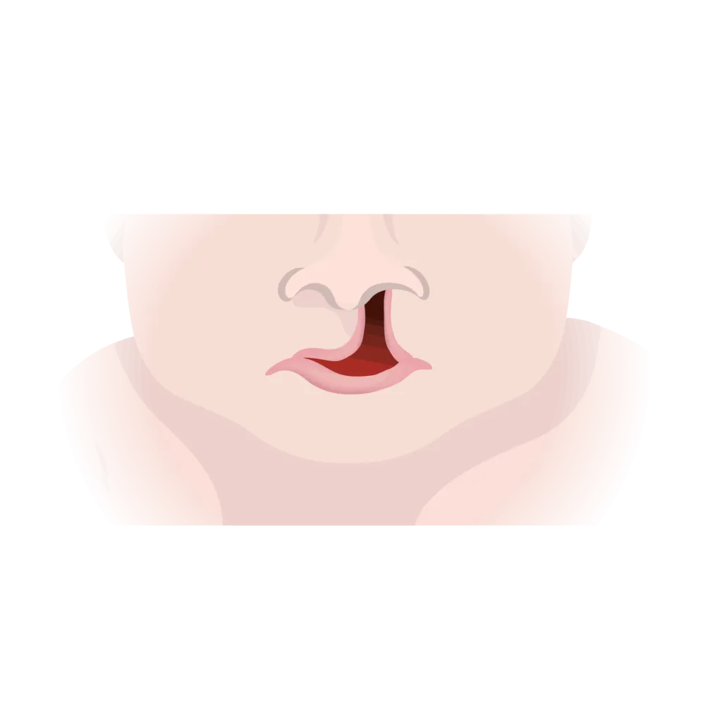 Cleft lip and palate 02