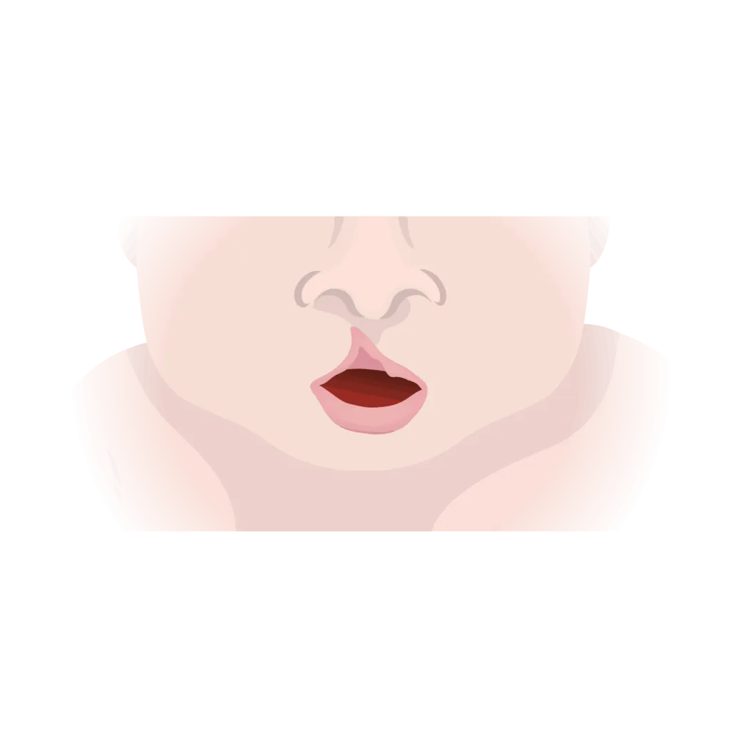 Cleft lip and palate 04