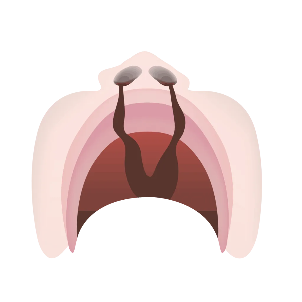 Cleft lip and palate 10
