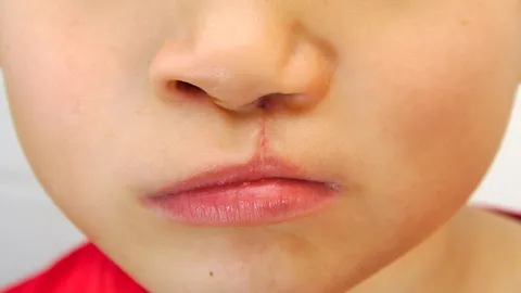 Cleft Lip and Palate: Types, Causes, Risks & Treatment