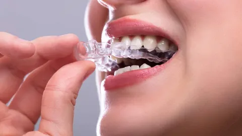 Invisalign for Crossbites: Better than Braces?