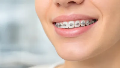 Overbite Treatment: 5 Options You Should Consider