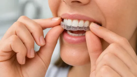 What Are Essix Retainers?