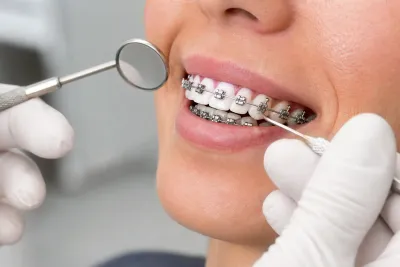 What Are Self-Ligating Braces?